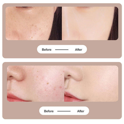 Skanto | Skanto Plasma Pen Laser for Tattoo and Mole Removal