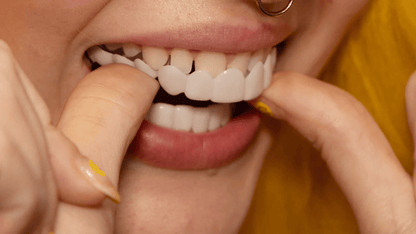 Kalsten | Instant Smile Transformation with Snap on Smile Veneers