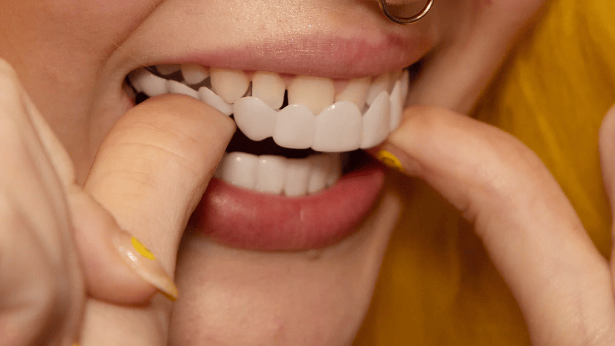 Instant enhancement of your smile with Snap-on Veneers
