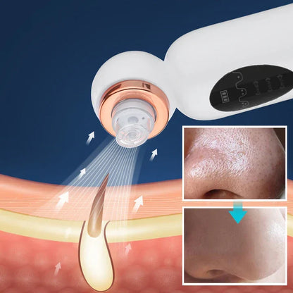 Skanto | Blackhead Remover and Hydrodermabrasion Device