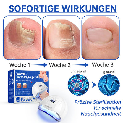 Skanto | PureNail™ | Nail Fungus Laser Treatment Device - Your Secret Weapon Against Nail Fungus