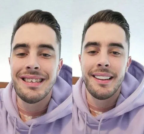 Skanto | On Smile Veneers (Upper and Lower Jaw Included)