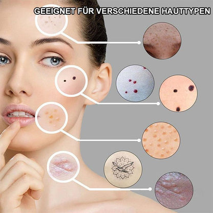 Laser treatment pen Blu-Ray remove unwanted acne