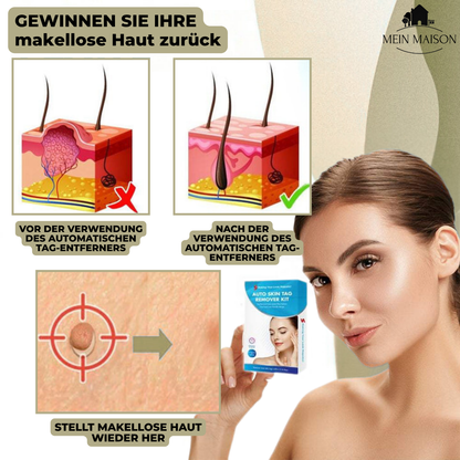Kalsten | DermaLinx Wart Remover | Pain-Free Removal of Warts & Moles | For Home | Without Surgery