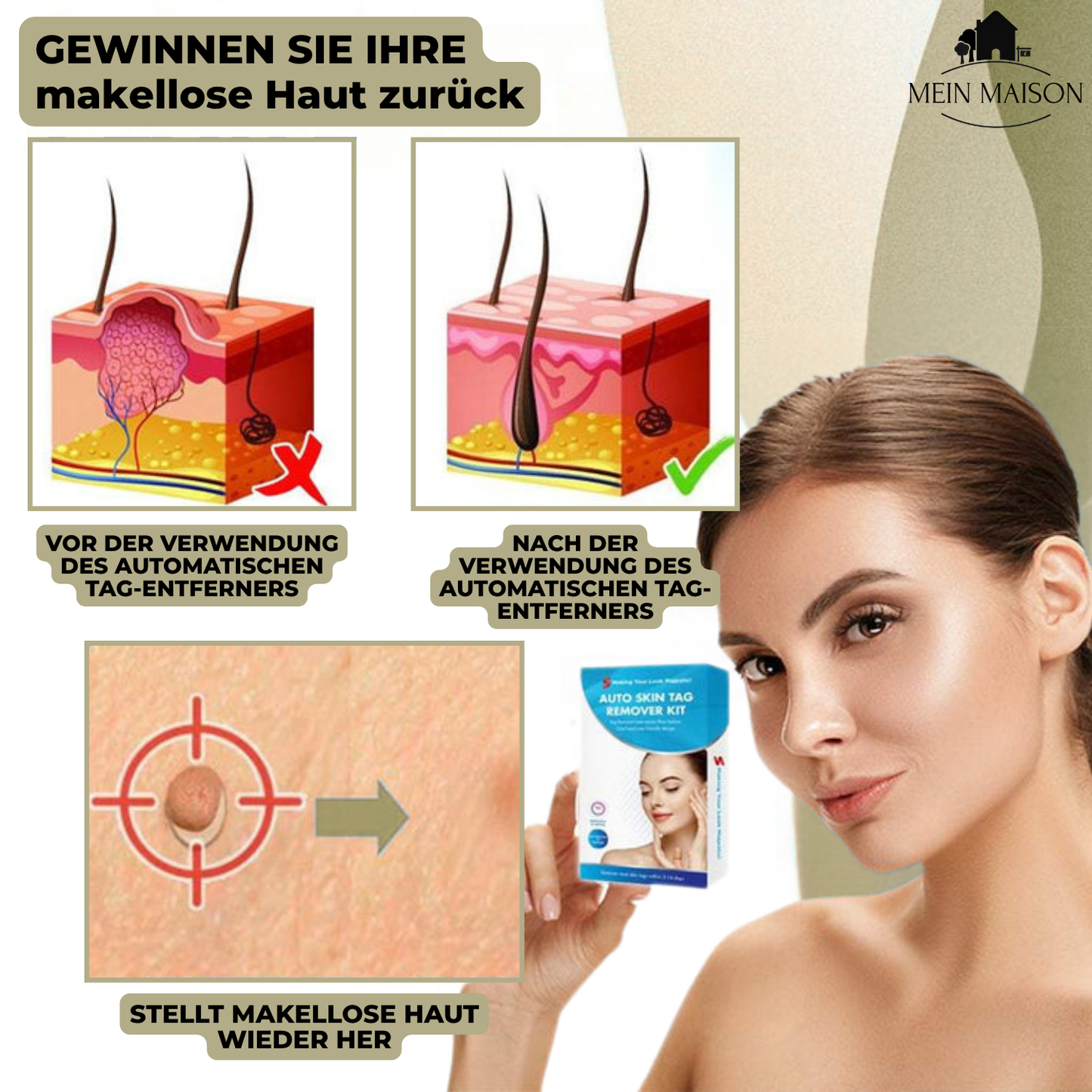 Skanto | DermaLinx Wart Remover | Pain-Free Removal of Warts and Moles | For Home Use | No Surgery