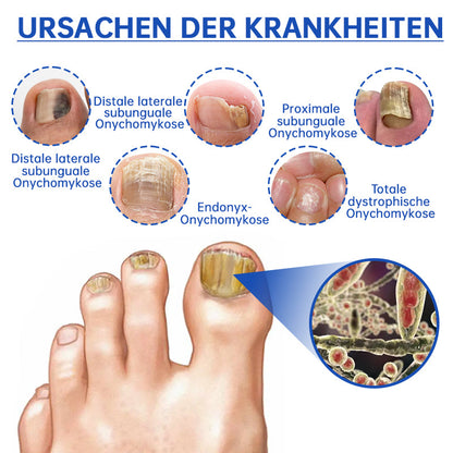 Skanto | PureNail™ | Nail Fungus Laser Treatment Device - Your Secret Weapon Against Nail Fungus