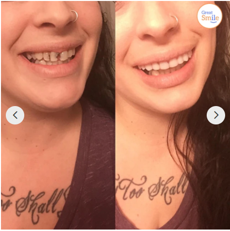 Kalsten |  - Snap-in Dental Prosthesis | 1+1 FREE!