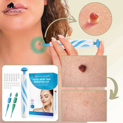 Skanto | DermaLinx Wart Remover | Pain-Free Removal of Warts and Moles | For Home Use | No Surgery