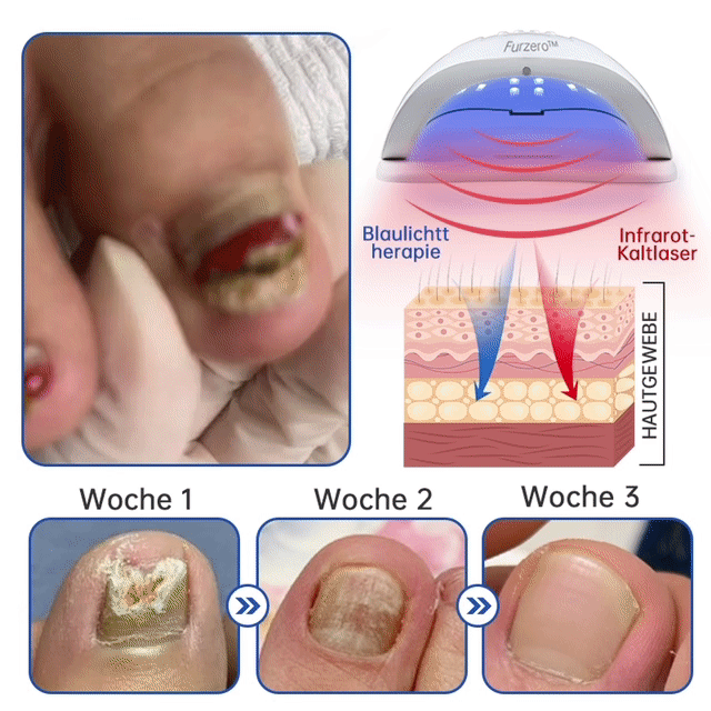 Skanto | PureNail™ | Nail Fungus Laser Treatment Device - Your Secret Weapon Against Nail Fungus