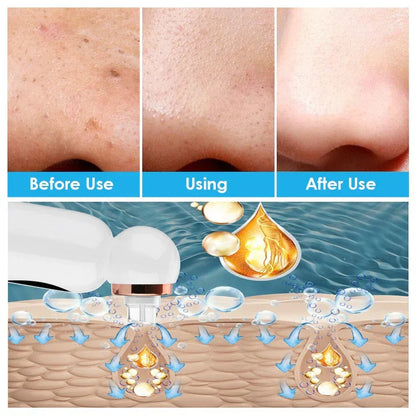 Skanto | Blackhead Remover and Hydrodermabrasion Device