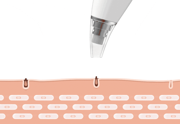 Skanto | Blackhead Remover Vacuum Pore Cleanser Tool
