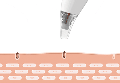 Skanto | Blackhead Remover Vacuum Pore Cleanser Tool