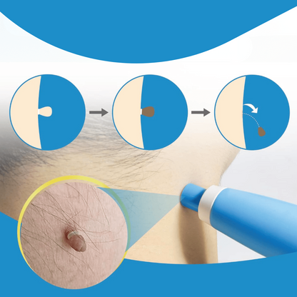 BowLift | WartAway – Natural Wart Remover