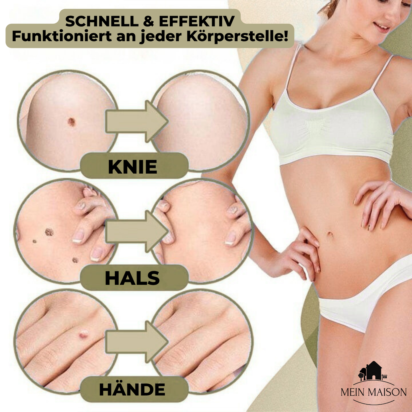 Skanto | DermaLinx Wart Remover | Pain-Free Removal of Warts and Moles | For Home Use | No Surgery