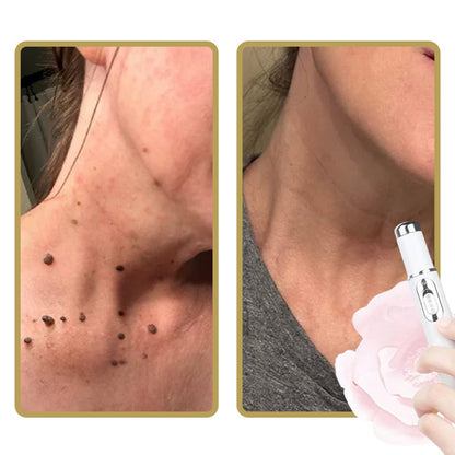 BowLift | ClearDerm - Quick, painless pimple removal for smooth, clear skin