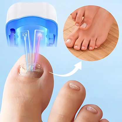 Skanto | Laser Nail Treatment Device for Fungus