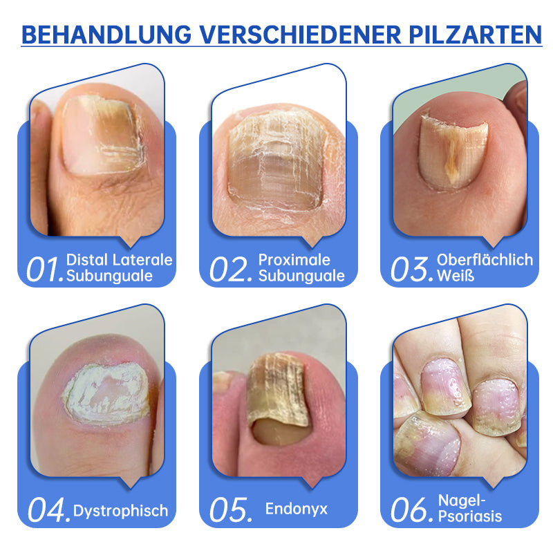 Skanto | PureNail™ | Nail Fungus Laser Treatment Device - Your Secret Weapon Against Nail Fungus