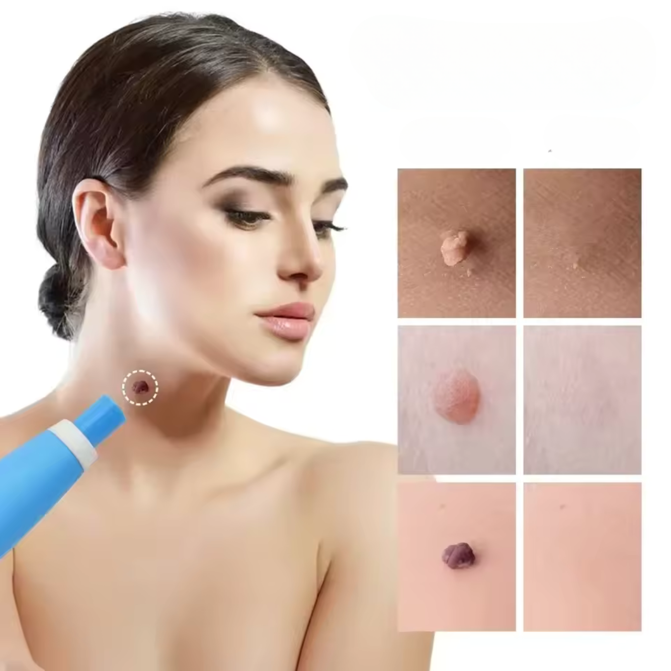 BowLift | WartAway – Natural Wart Remover