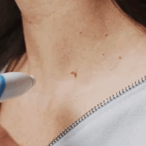 Skanto | SmoothZap — Faster pain-free skin freedom for a new sense of confidence in just 10 days