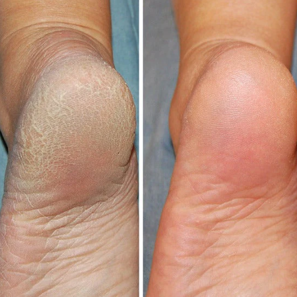 BowLift | Silicon-Spa-Socks - Intensive care for cracked and tired feet