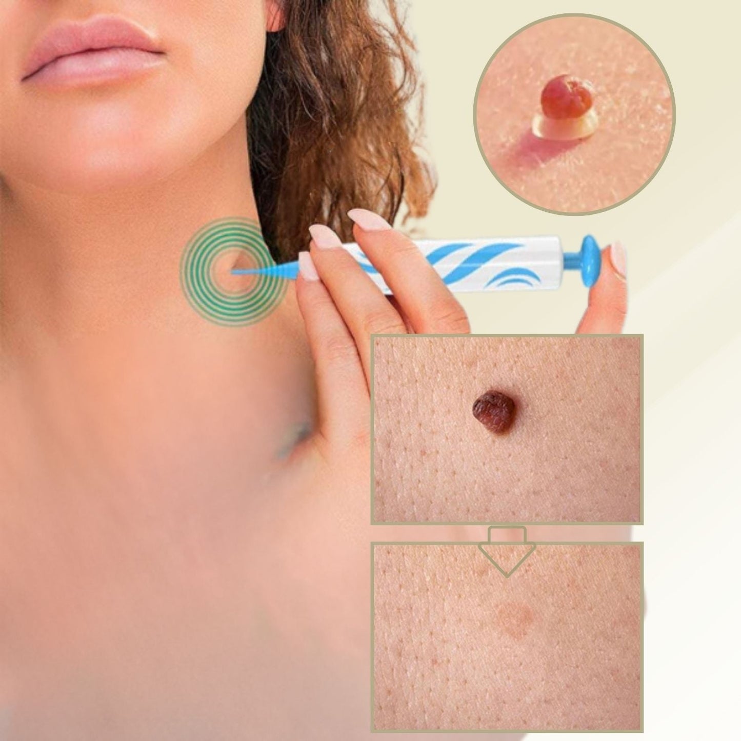 Skanto | DermaLinx Wart Remover | Pain-Free Removal of Warts and Moles | For Home Use | No Surgery