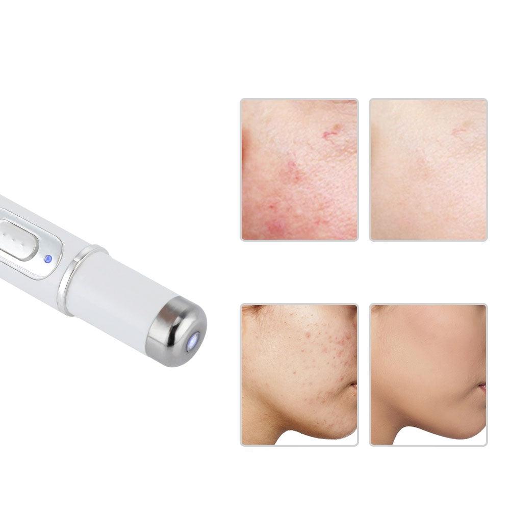 Skanto | LUCY – Blue Light Laser Pen for Precise Treatment