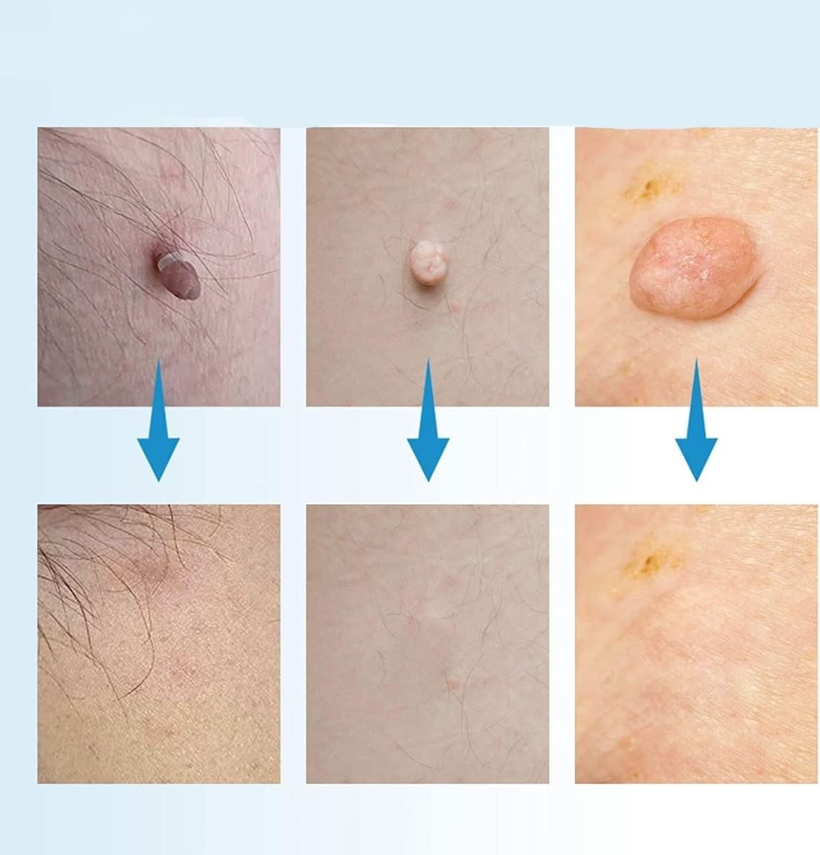BowLift | Skin spot remover for warts & skin tags