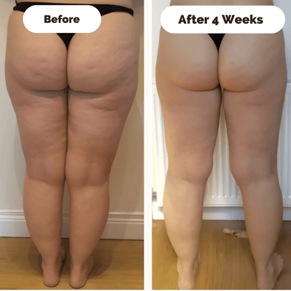 Skanto | Skin Tightening Massager for Cellulite