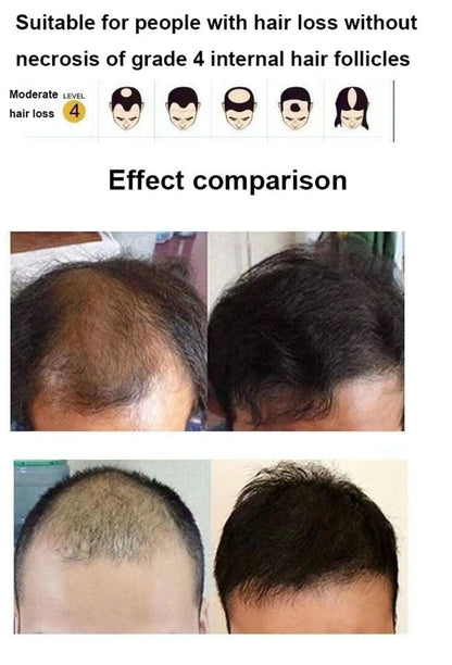 Red Light Therapy Hair Growth Hat