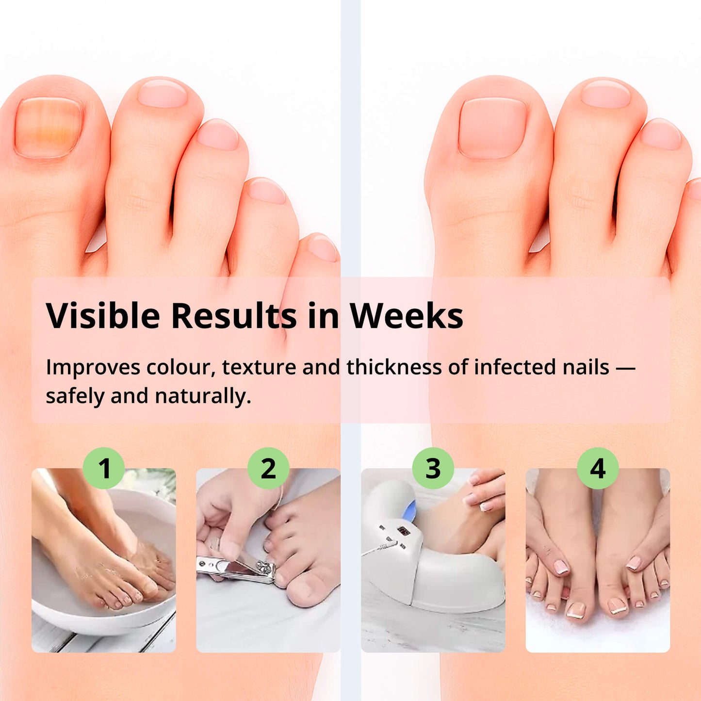 BowLift | Laser Nail Fungus Removal Device | Advanced Home Treatment with Red & Blue Light for Healthy Nails