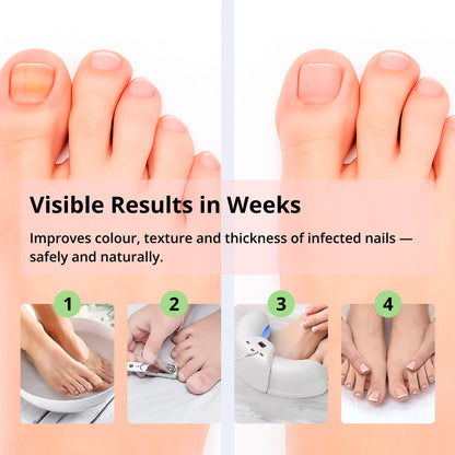 BowLift | Laser Nail Fungus Removal Device | Advanced Home Treatment with Red & Blue Light for Healthy Nails