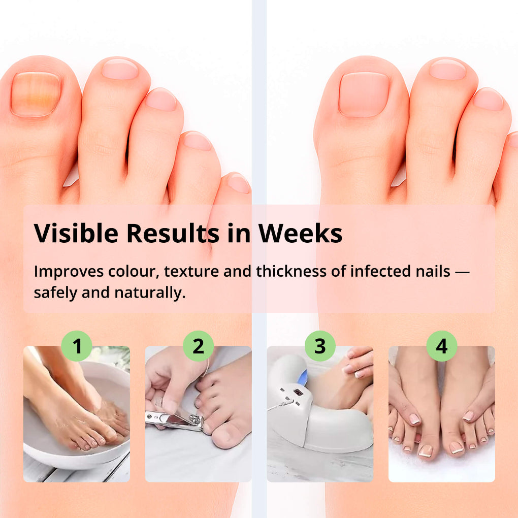 Skanto | Laser Nail Treatment Device – Red and Blue Light for Nail Fungus