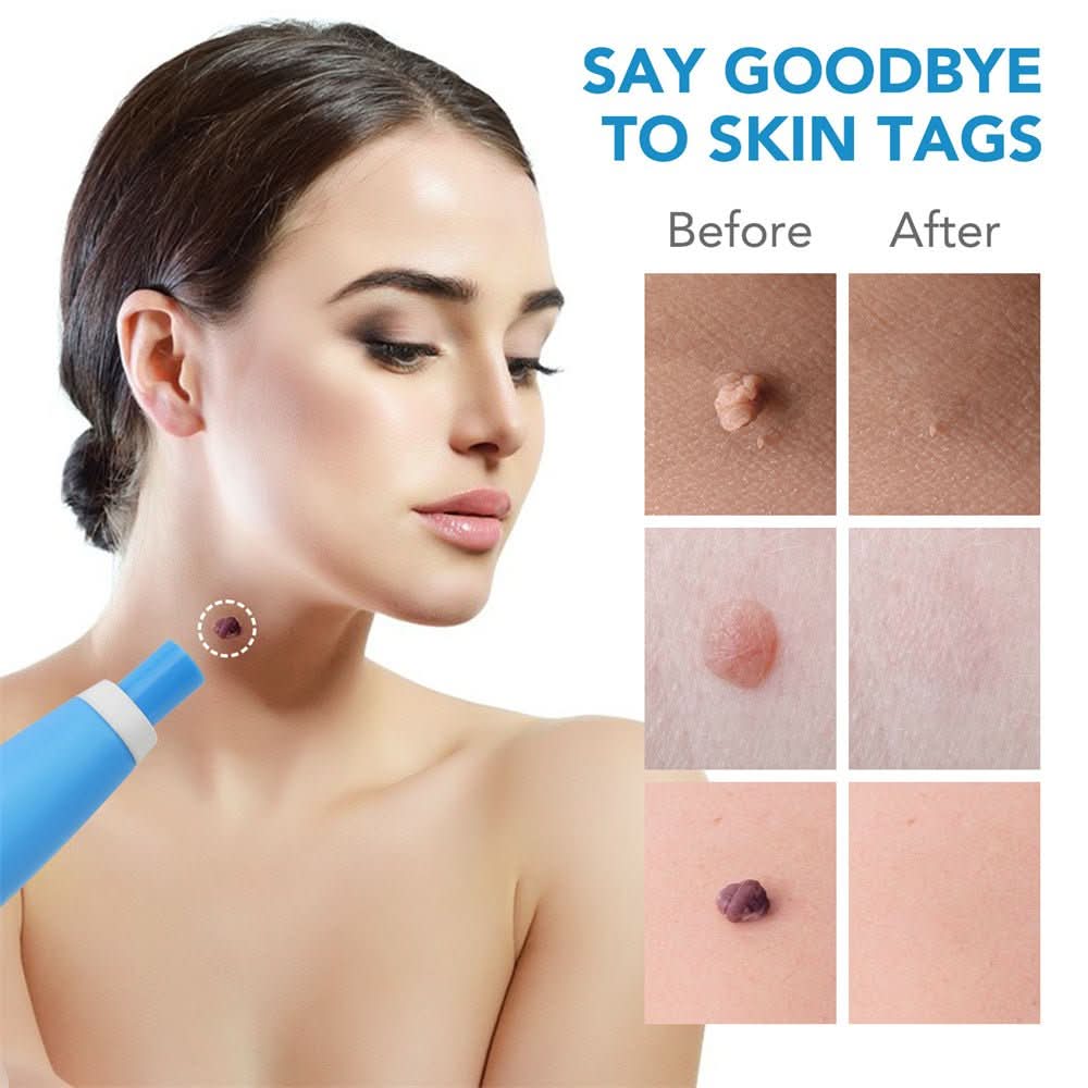 Preparations for the removal of skin spots, warts and skin tags