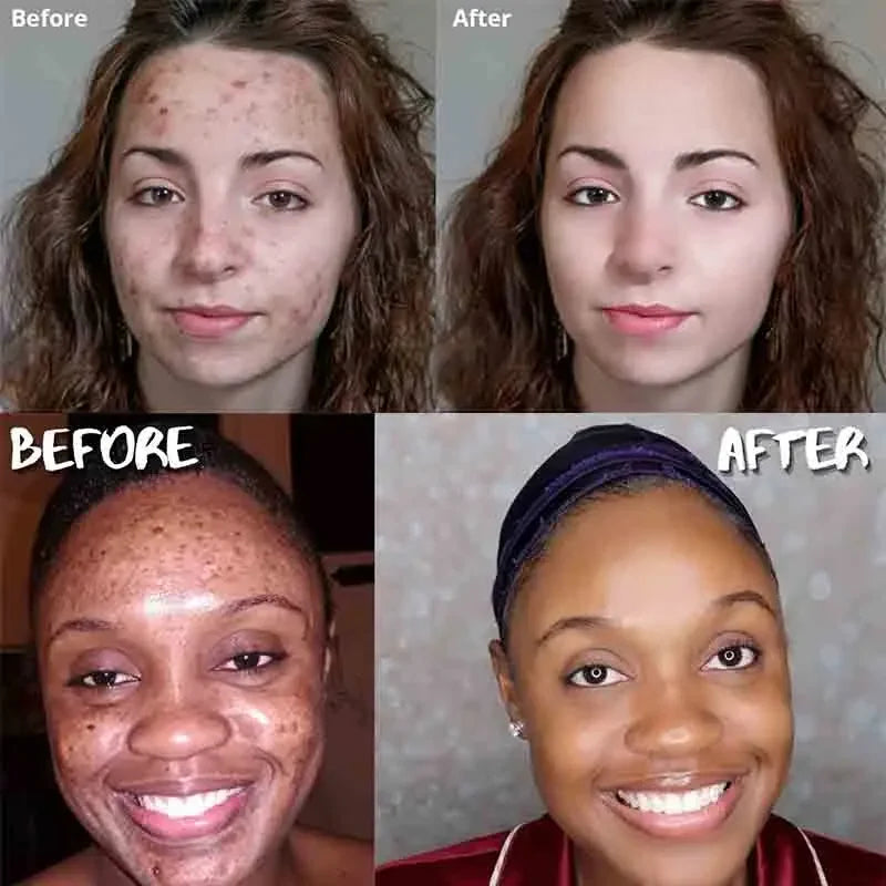 Sandsberg | Turmeric Soap Facial Cleansing Anti-Acne Removes Pimples Dark Spots