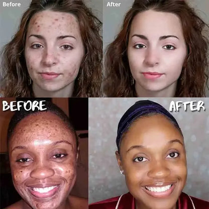 Sandsberg | Turmeric Soap Facial Cleansing Anti-Acne Removes Pimples Dark Spots
