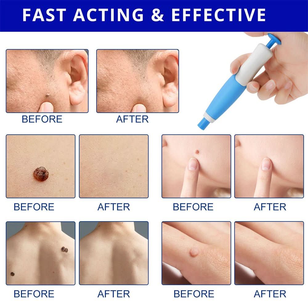 BowLift | Skin spot remover for warts & skin tags