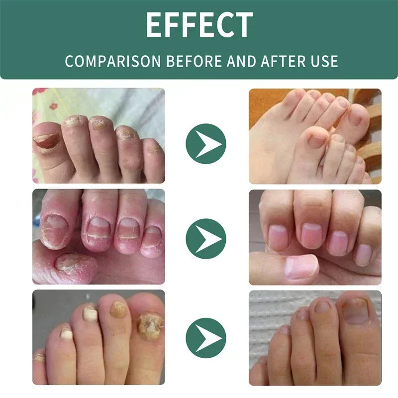 BowLift | Nail Fungus Defender Serum