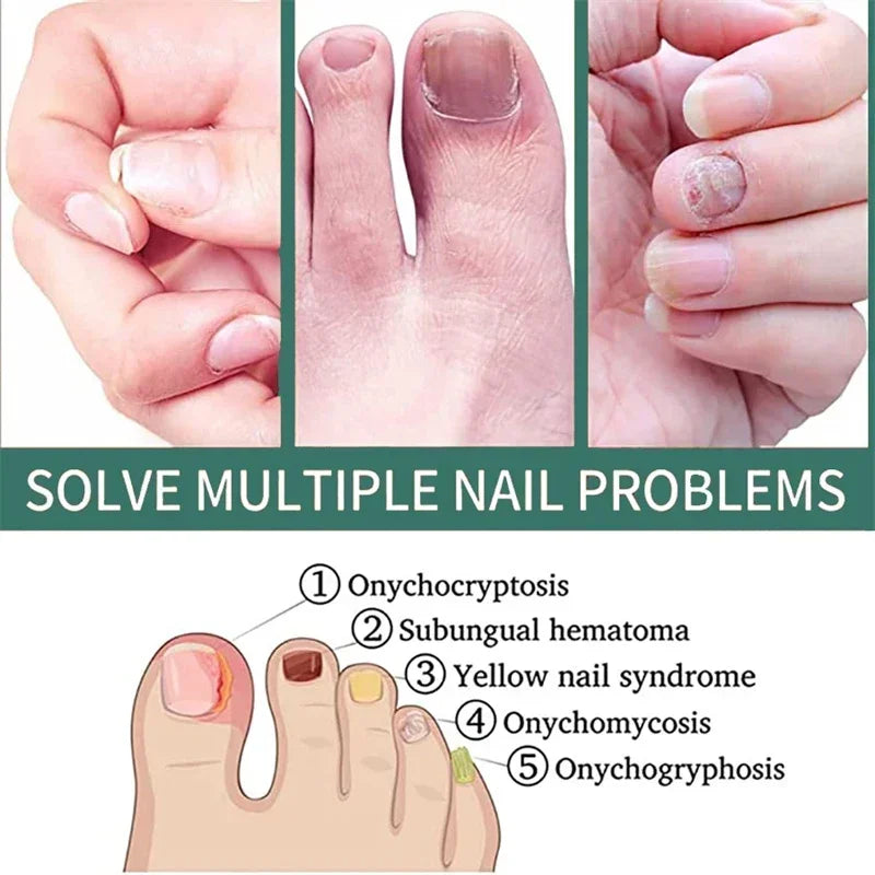 BowLift | Nail Fungus Defender Serum