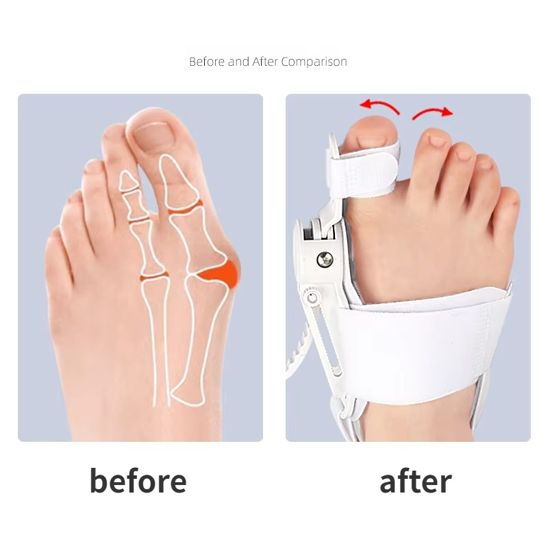 BowLift | Hallux Valgus Bunion Corrector Toe Separator Foot Alignment Support