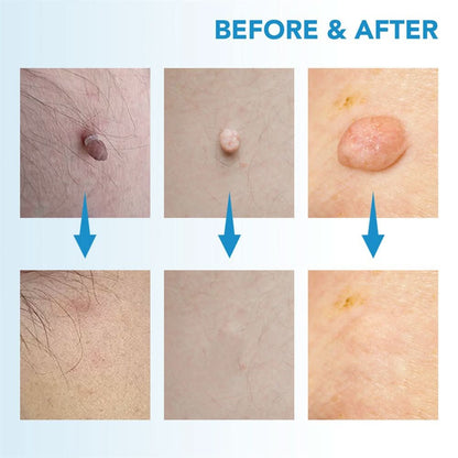 BowLift | Skin spot remover for warts & skin tags