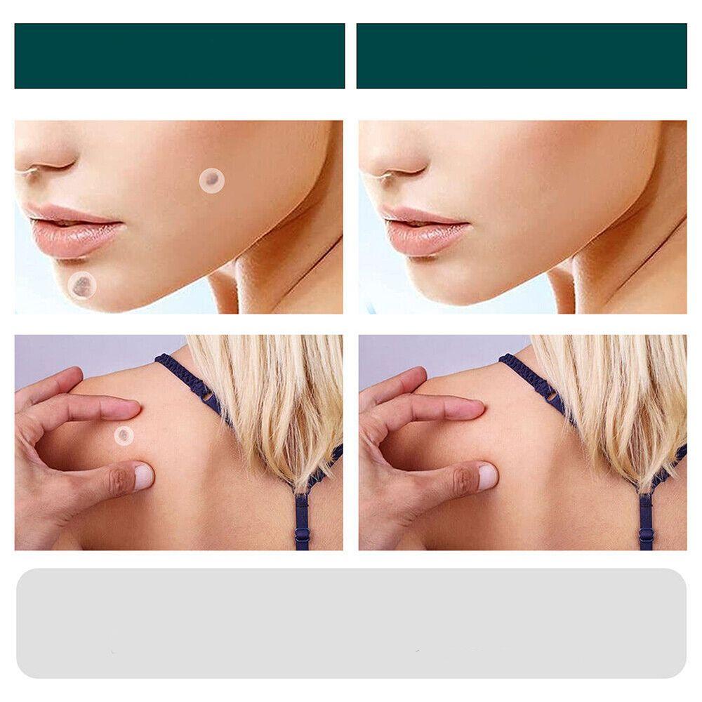 Skanto | SkinClear - Plaster for the removal of spots and warts
