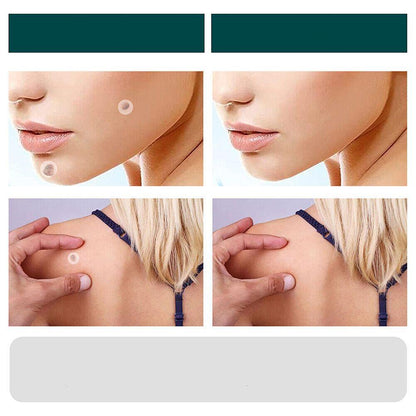 Skanto | SkinClear - Plaster for the removal of spots and warts