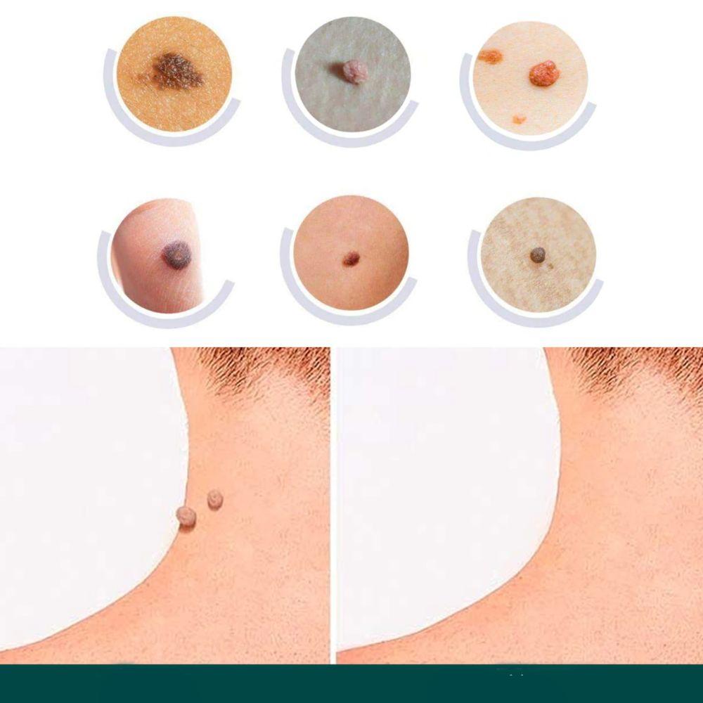 Skanto | SkinClear - Plaster for the removal of spots and warts