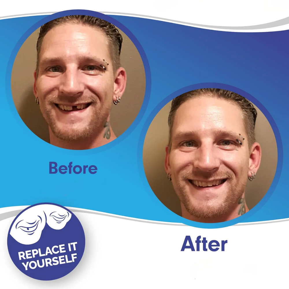 BowLift | Removable Veneers Teeth Cover