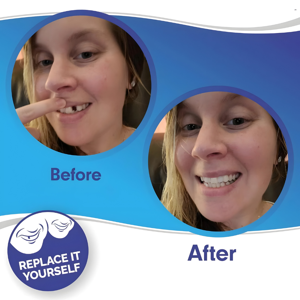 Removable Veneers - Dental Veneers