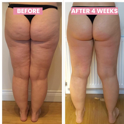 Skanto | Anti-cellulite Cupping Device - SlimCupp