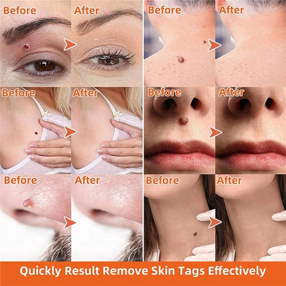 Skanto | Auto Skin Tag Remover Painless
