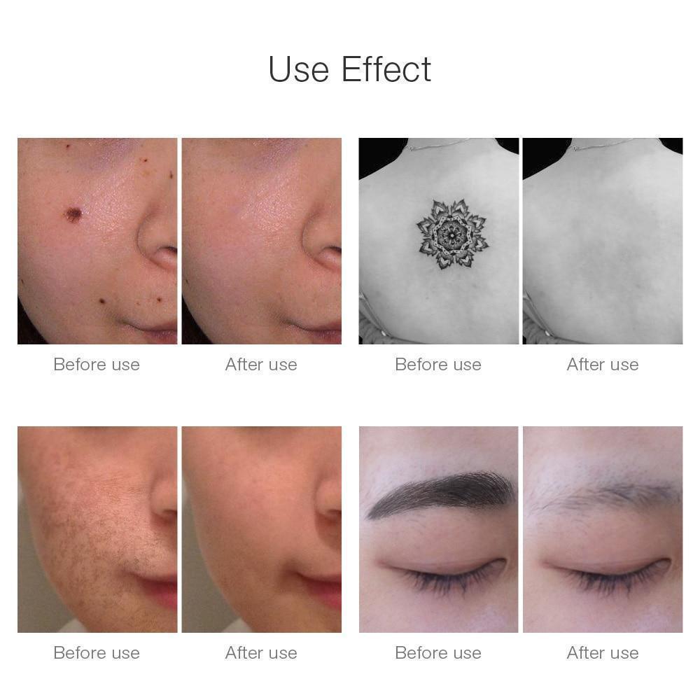 BowLift | Instant Laser Dark Spot & Tattoo Remover