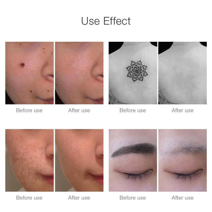 BowLift | Instant Laser Dark Spot & Tattoo Remover