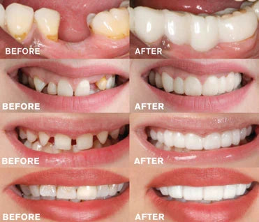 Sandsberg - Snap-in Dentures | 1+1 FREE!